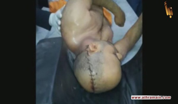 تقارير تؤكد سرقة السعودية الأعضاء البشرية لضحاياها